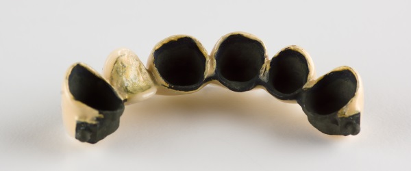 Metal-ceramic tooth crowns with locks for fixing removable prostheses